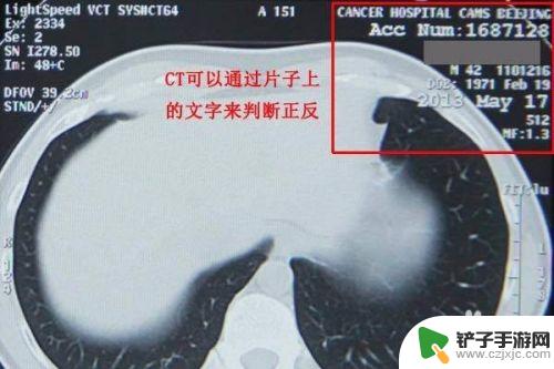 手机上怎样查医院ct片子 手机拍照医院检查影像片子步骤